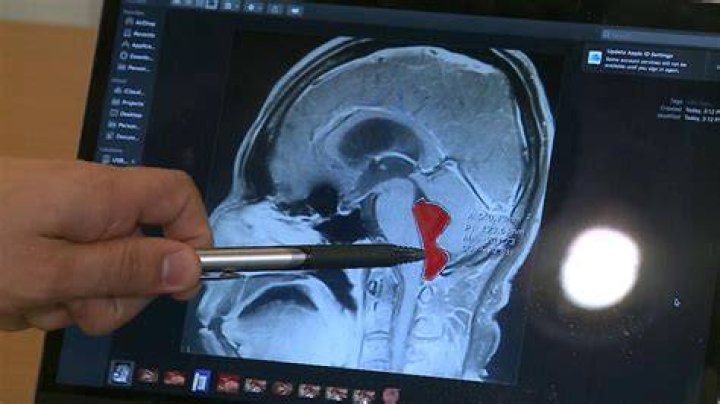 A Man Suffered Splitting Headaches for Years. Turns Out, Tapeworms Were Living in His Brain