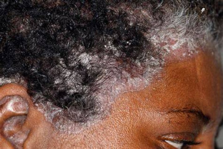 African American Patients with Psoriasis at Even Greater Risk of Atherosclerotic Heart Disease