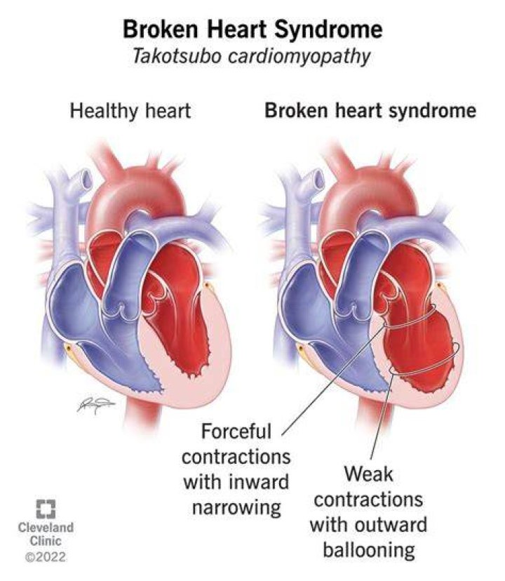 Broken Heart Syndrome Is Real, and It&rsquo;s Disproportionately Affecting Women During the Pandemic