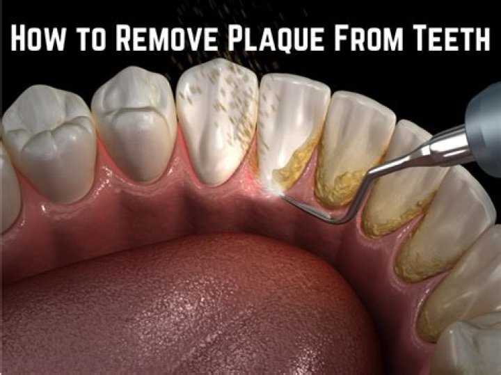 Could Benefit of Plaque Removal Grow in Time?