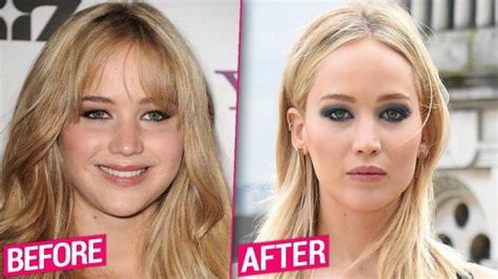 Did Jennifer Lawrence have plastic surgery?