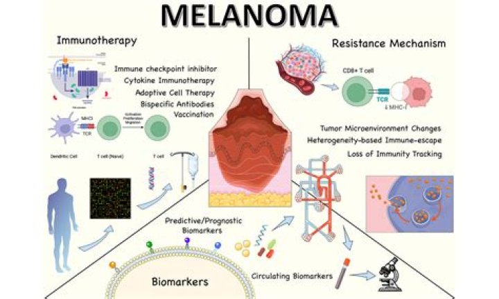 Timing of Melanoma Immunotherapy Could Be Key to Outcomes: Study