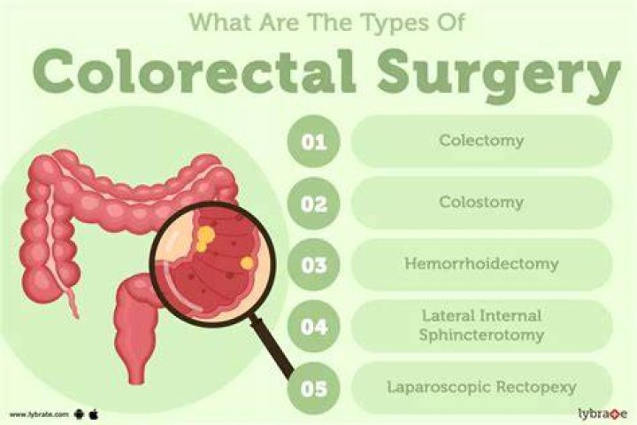 Types of Surgery for Colon Cancer: How to Prep and What to Expect After Surgery