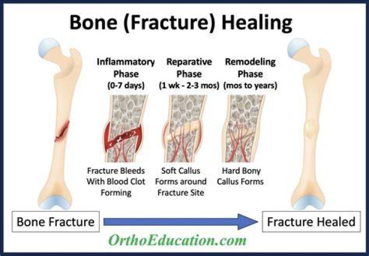 We Broke the Same Bone. My Recovery Was a Breeze, Hers an Ordeal. Why?