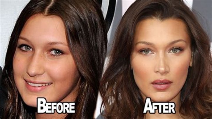What type of plastic surgery did Bella Hadid have?